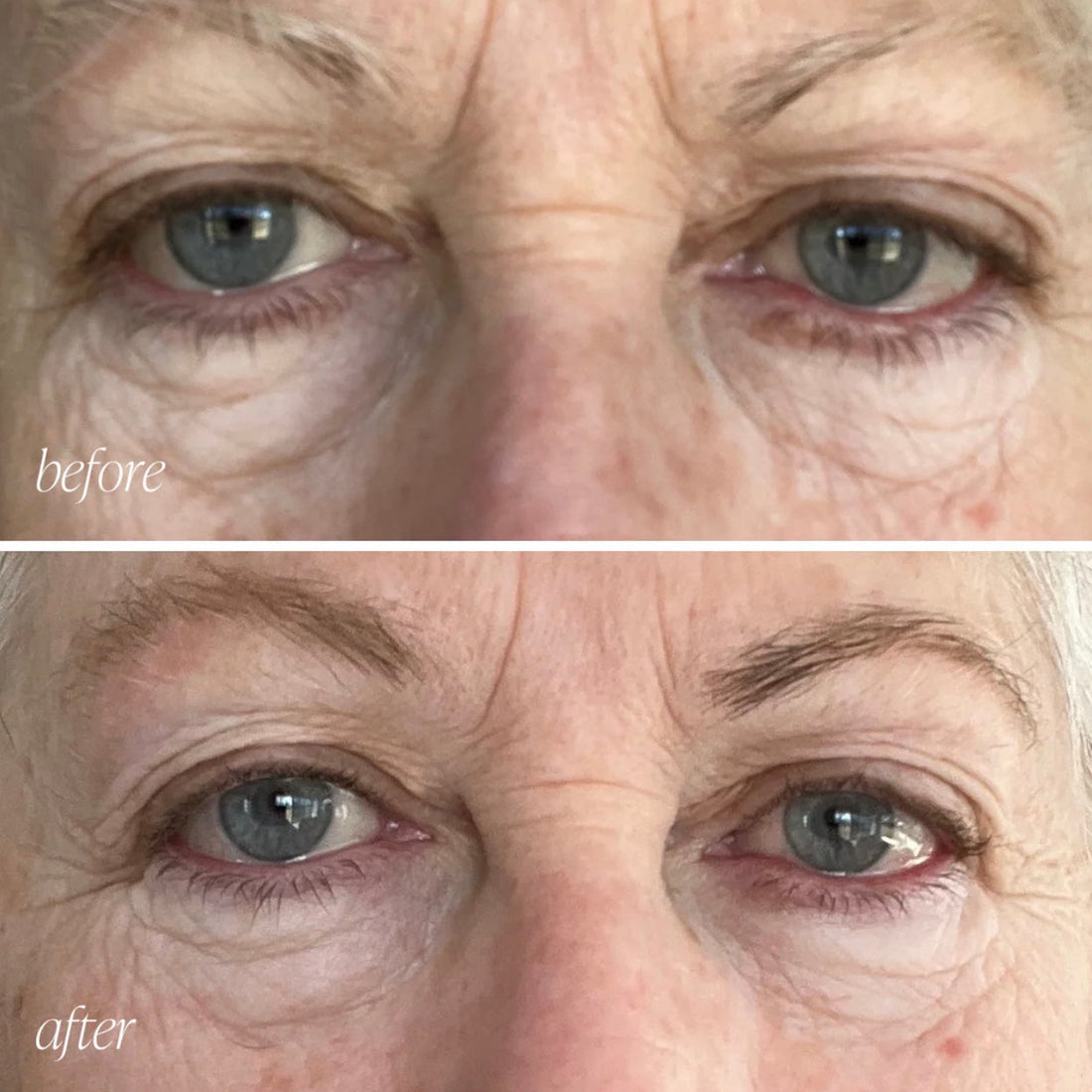 Reduce las Líneas de Expresión y las Arrugas