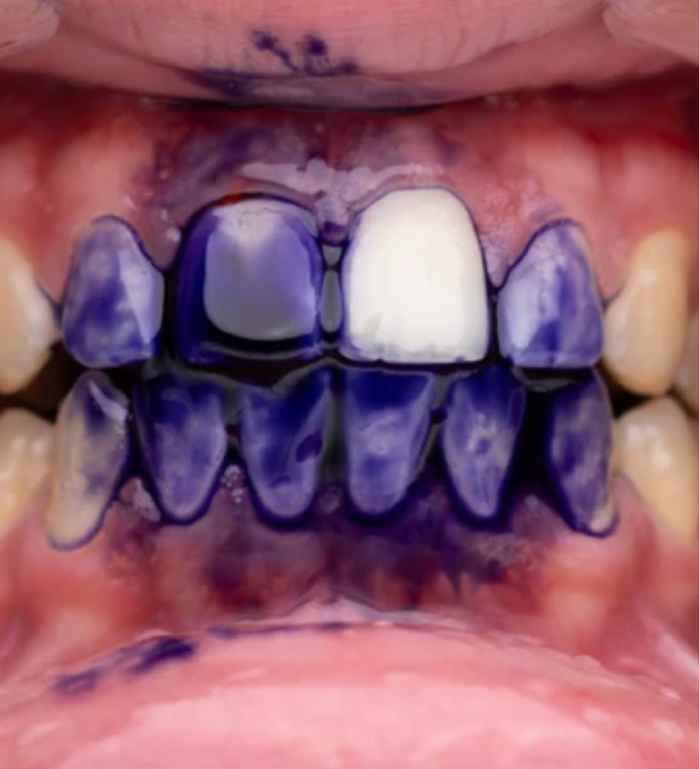 Purple V34 - Blanqueador Dental