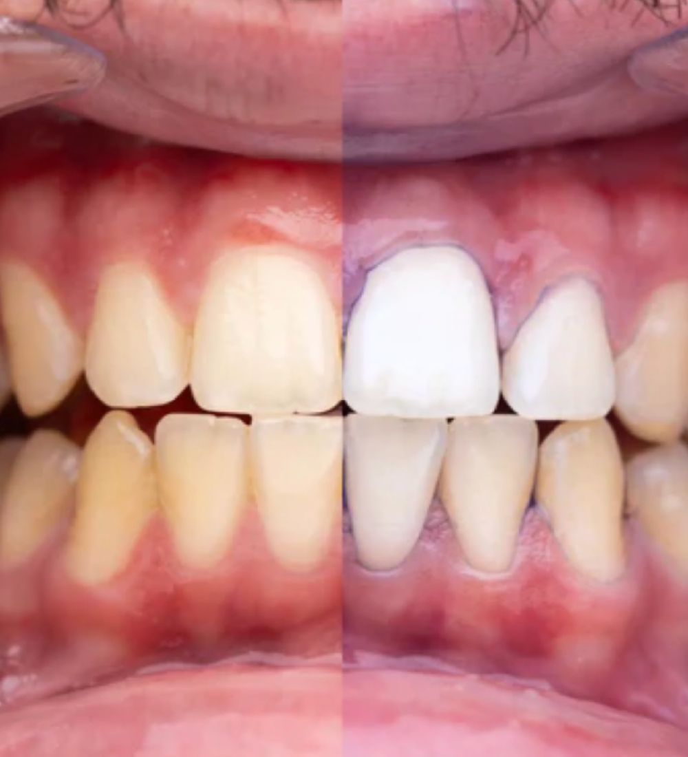 Purple V34 - Blanqueador Dental