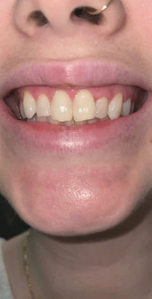 Before - 